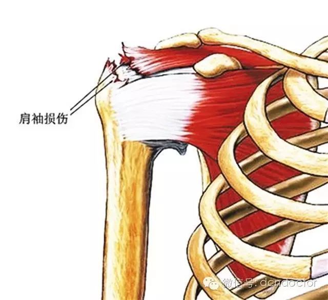 其中肩袖缝合术40余例,现将肩袖缝合术后部分患者的随访资料做以下