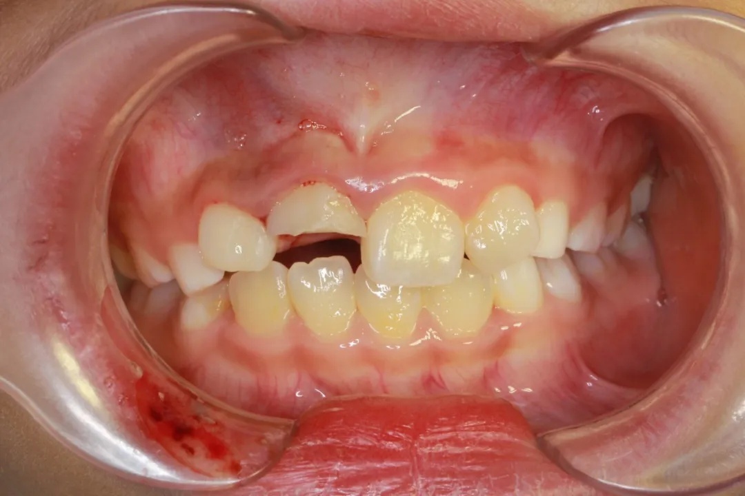 孩子牙断裂怎么办?请把断牙放在牛奶或生理盐水来医院