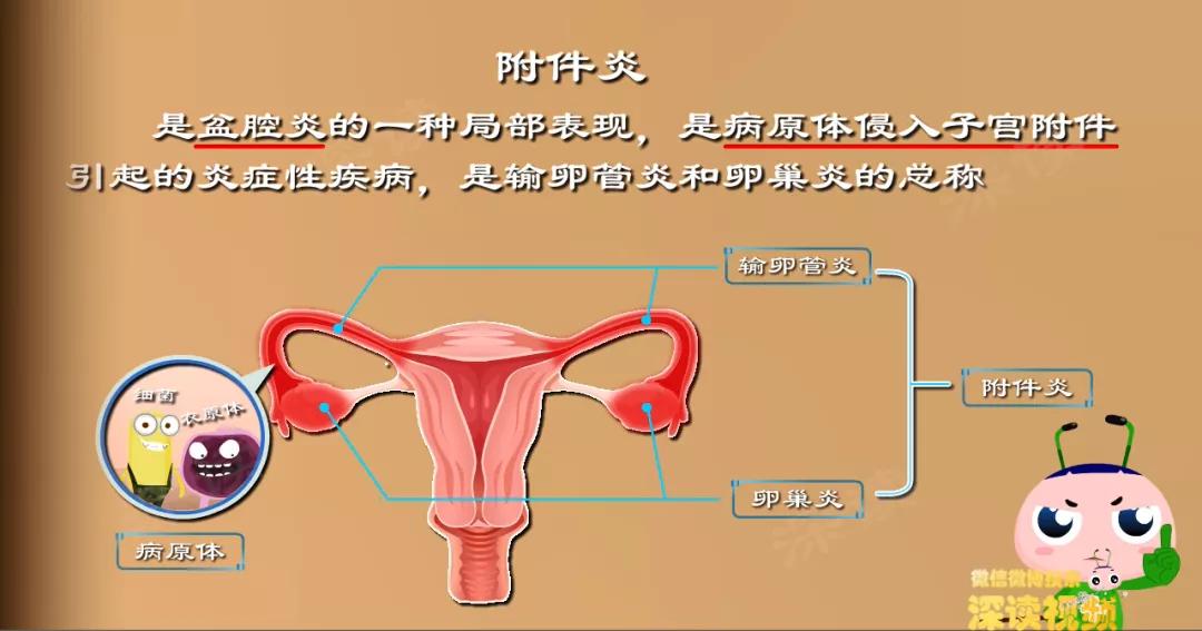 附件炎是盆腔炎的一种局部表现