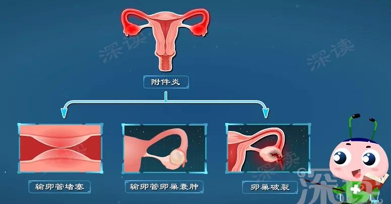 附件炎疼痛位置图片图片